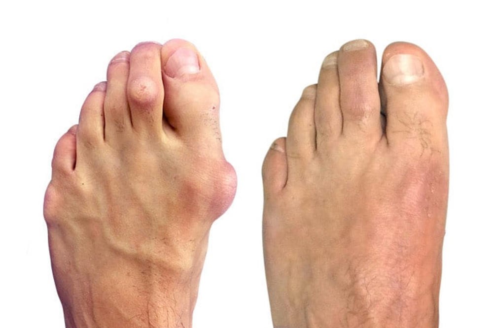 Simptomi noga artroze i zglobova na nozi s fotografijama
