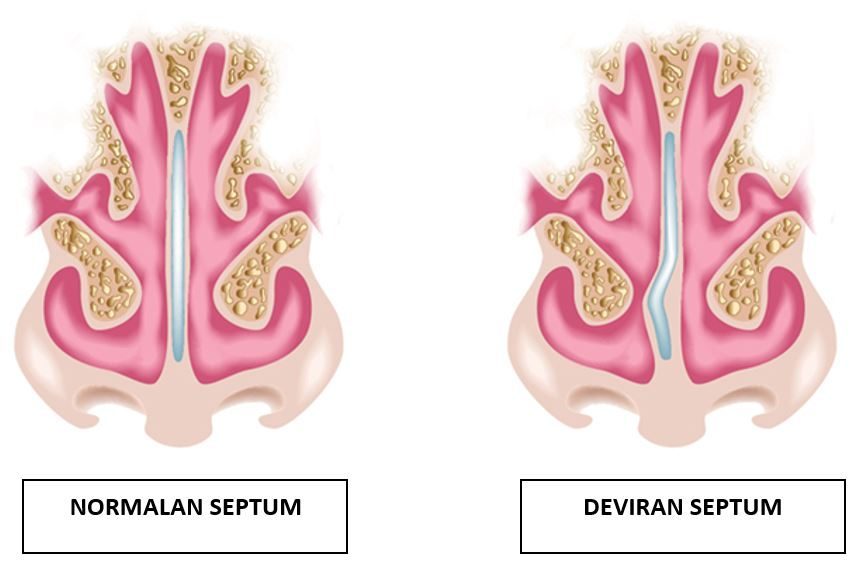 Normalan i deviran septum