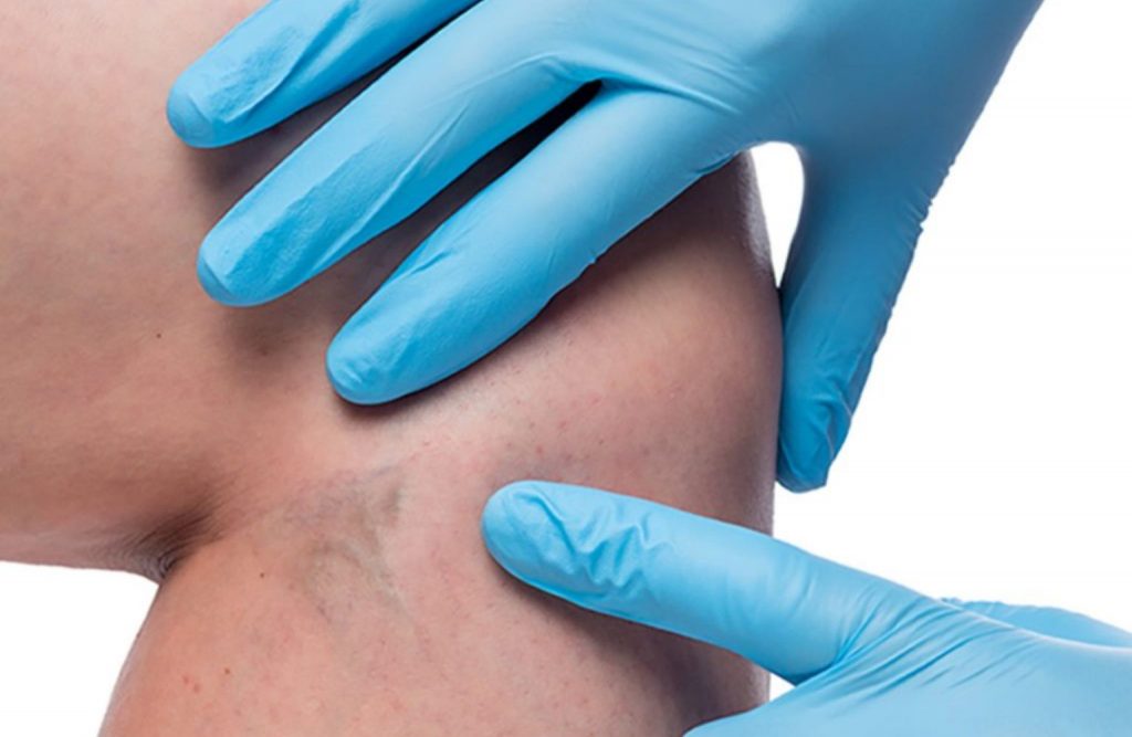 vs_clinic_and_beauty_kampanja_problem_proširenih_vena_besplatni_pregledi