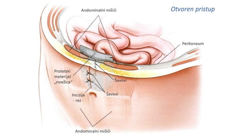 Operacija Hernije