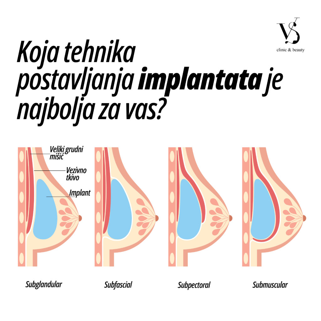 položaj implantata kod operacije grudi