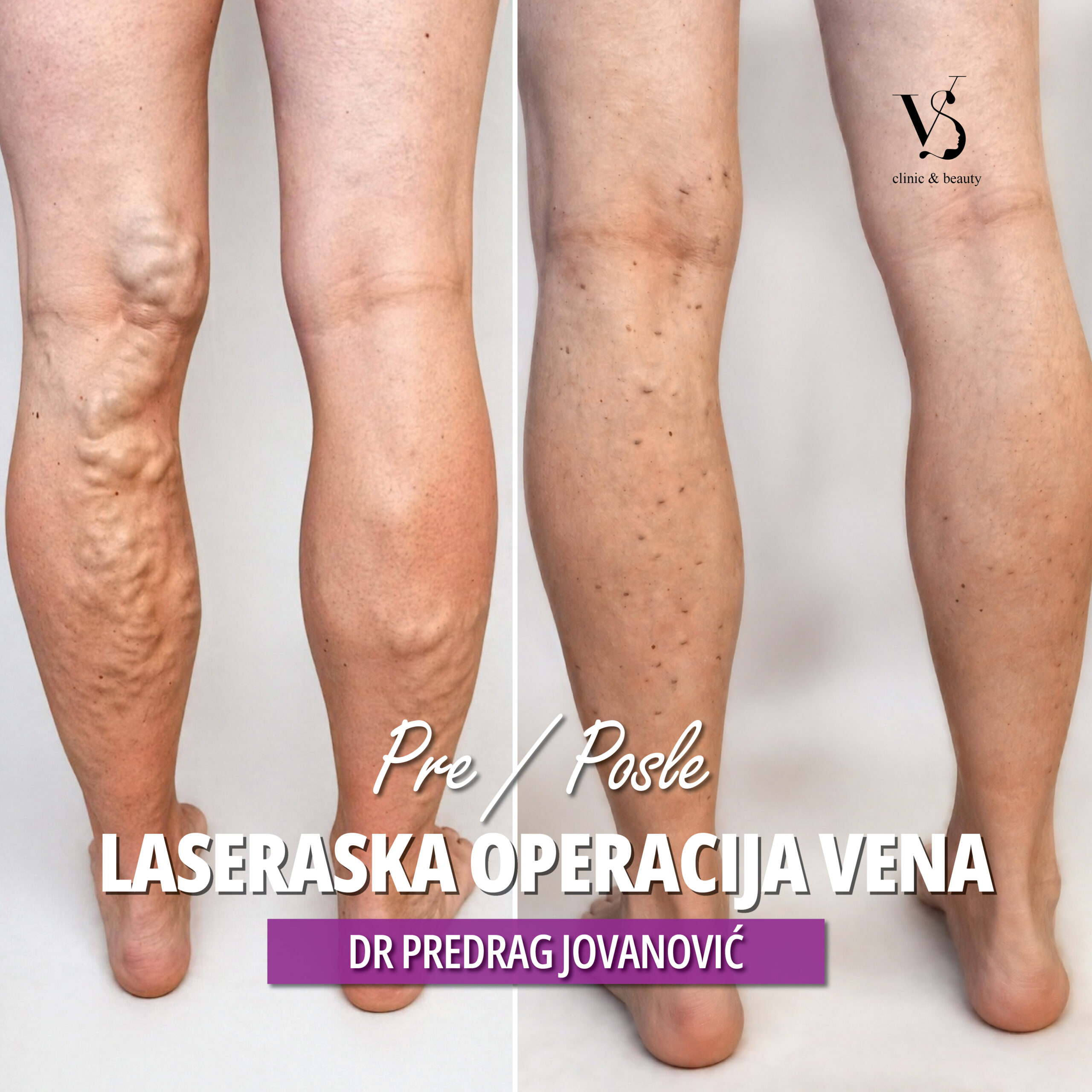 Pre i posle operacije vena
